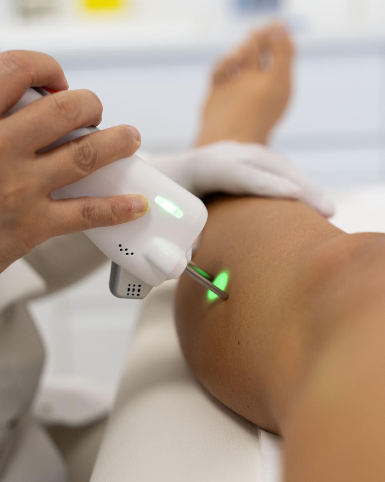 Épilation laser définitive à Nice